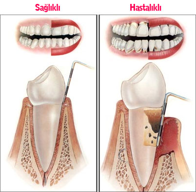 Periodontoloji Nedir?